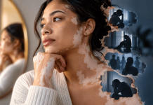 Vitiligo Is Visible. AbbVie Is Marketing What Patients Can’t See. Woman with vitiligo looking thoughtfully into the distance, with shadowy scenes representing anxiety, depression, and isolation, highlighting the hidden emotional burden of the condition.